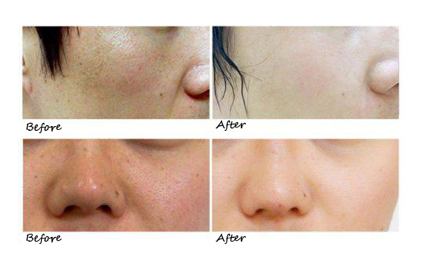 水光針的效果怎么樣？