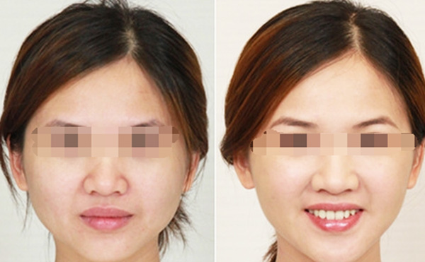 瘦臉針的效果怎么樣？