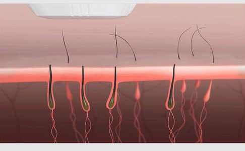 全身脫毛永久的大概需要多少錢？