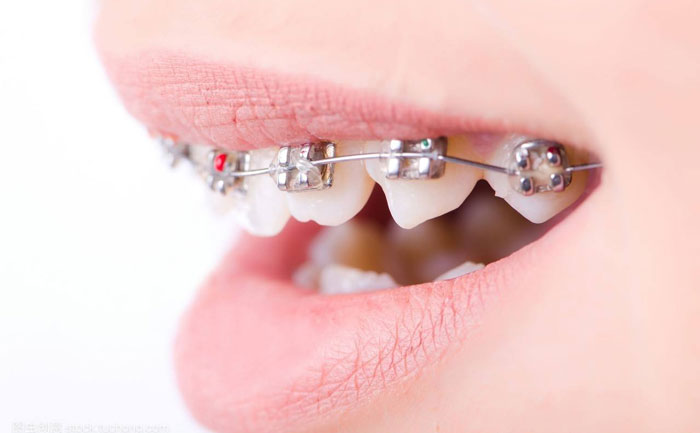 口腔正畸的最佳治療方法？口腔正畸的最佳年齡是多少？
