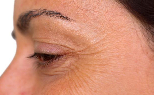 眼角紋怎么消除簡單方法？眼角紋去除要多少錢？