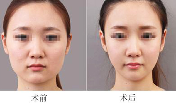 面部吸脂會(huì)導(dǎo)致臉下垂嗎？