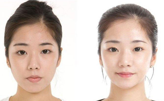 面部吸脂瘦臉的副作用？