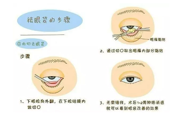 內(nèi)切去眼袋安全性怎么樣?內(nèi)切去眼袋會復發(fā)嗎?