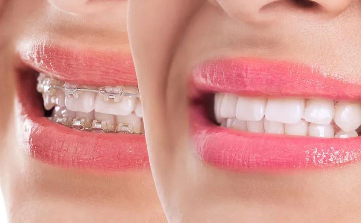 齙牙矯正大概需要花費(fèi)多少錢？齙牙矯正可以改善凸嘴嗎？