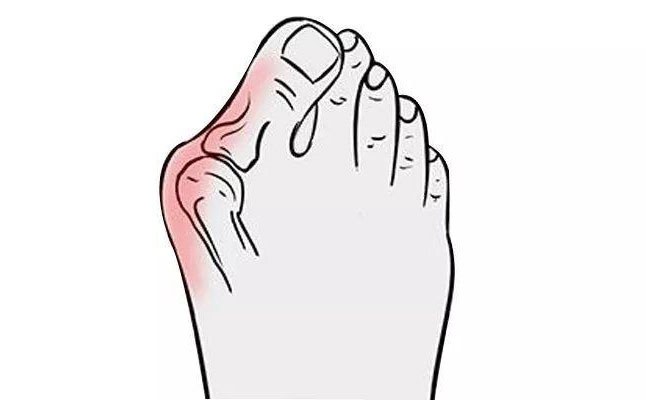 大腳骨矯正手術(shù)多少錢(qián)？大腳骨矯正三個(gè)月可以恢復(fù)嗎？