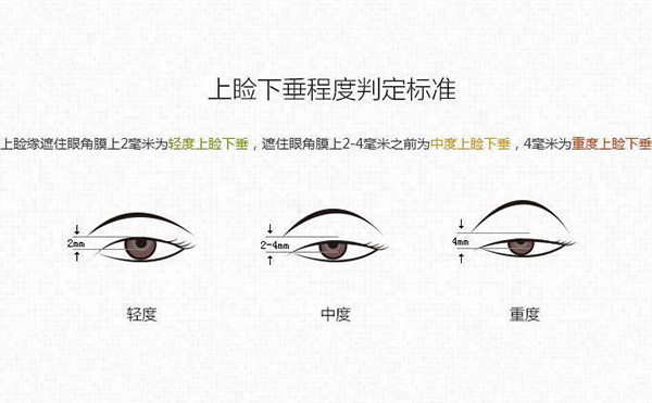 上瞼下垂一定要做嗎?上瞼下垂修復(fù)效果好嗎?