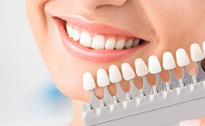 牙齒美白哪種方法好？