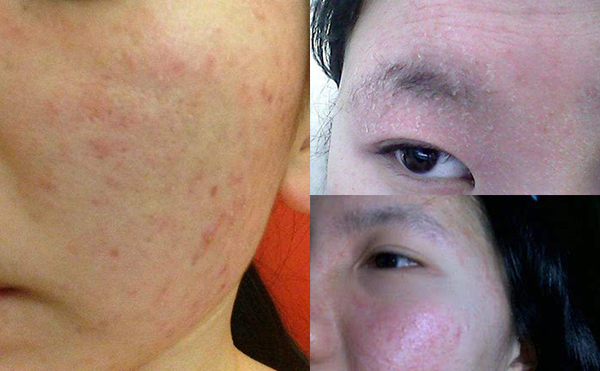 果酸煥膚有哪些風(fēng)險(xiǎn)和弊端？