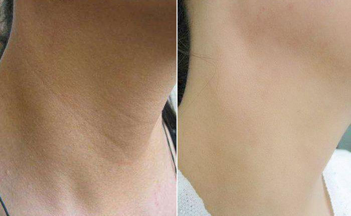 嗨體去頸紋效果怎么樣？