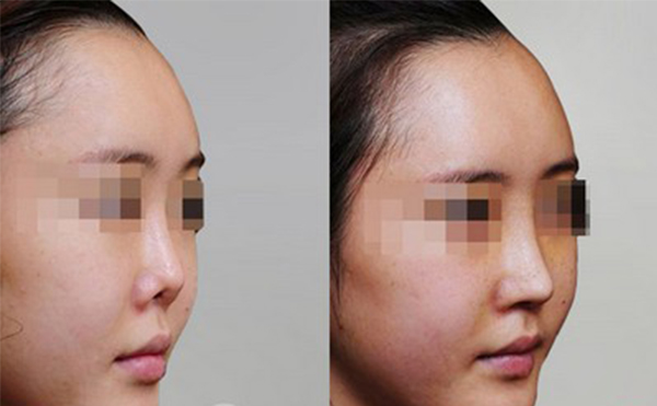 修復后的鼻翼缺損是否真實？