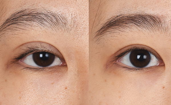 眼部修復(fù)風(fēng)險(xiǎn)大嗎？眼修復(fù)價(jià)格是多少？