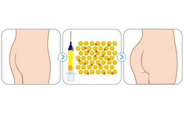 自體脂肪豐臀優(yōu)勢(shì)是什么?適合哪些人群?