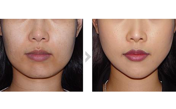 面部吸脂可以多次進(jìn)行嗎？