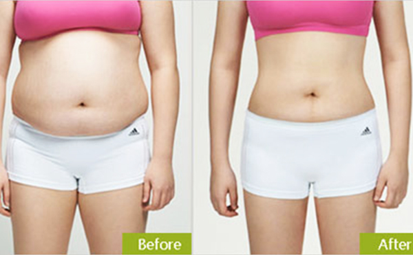 腰腹吸脂有什么優(yōu)勢？