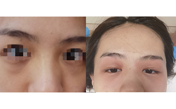 光子嫩膚去黑眼圈怎么樣？