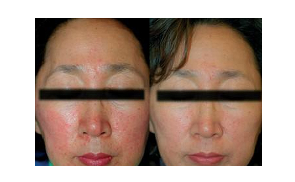 復(fù)合彩光去紅血絲痛不痛？