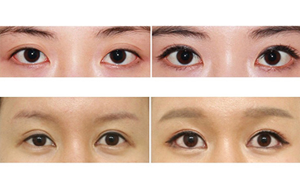 為什么醫(yī)生不建議開外眼角？