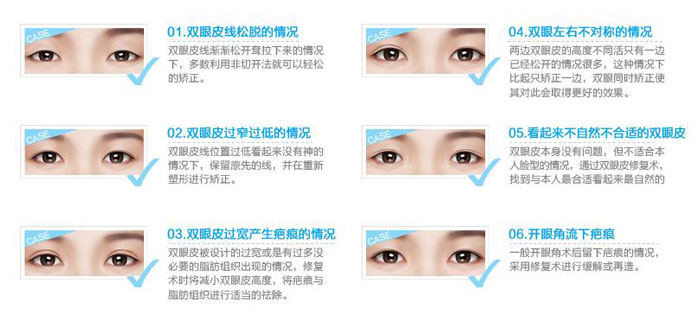 雙眼皮修復(fù)手術(shù)成功率高嗎？雙眼皮修復(fù)的最佳時(shí)間