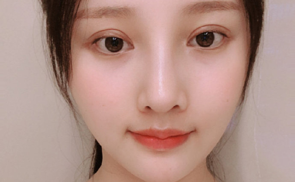 北京聯(lián)合麗格下頜角整形案例術(shù)后兩個(gè)月