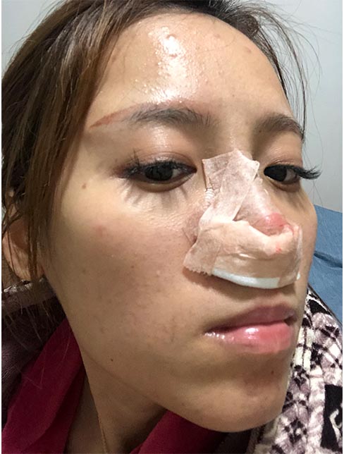 肋軟骨鼻綜合案例:恢復(fù)期效果