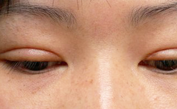 埋線雙眼皮失敗該如何修復(fù)？多久修復(fù)好？