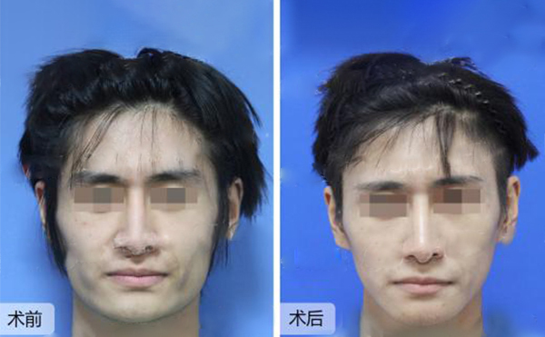 做下頜角整形風險有哪些？