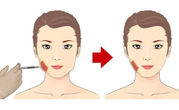溶脂針、瘦臉針的適宜人群是哪些?