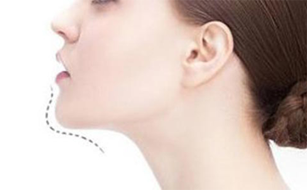 玻尿酸豐下巴好嗎？做玻尿酸豐下巴需要注意什么