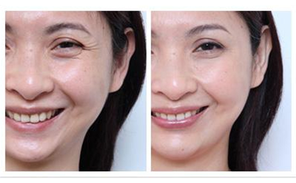 去魚尾紋多少錢？