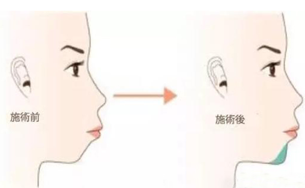 注射愛貝芙墊下巴多少錢?有什么特點(diǎn)?