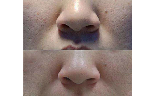 光子嫩膚適合哪個年齡段？