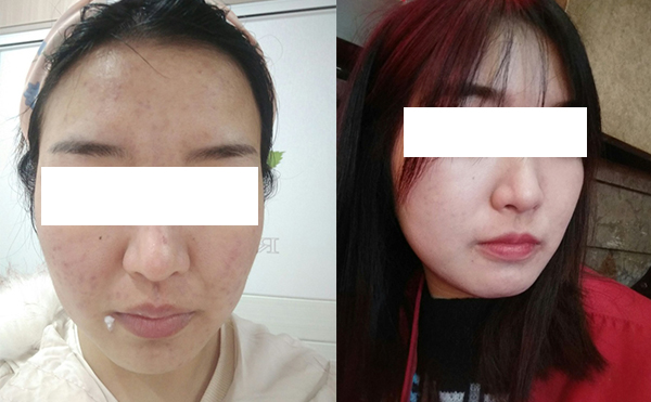 美白針可以維持多久？