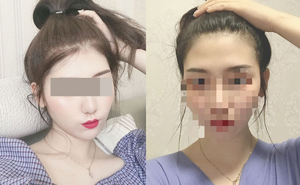冰點(diǎn)脫毛后多久可以洗澡嗎？