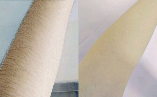 光子脫毛有疼痛感嗎？