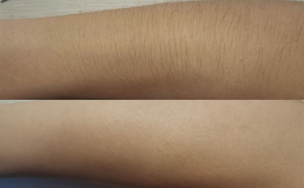 冰點(diǎn)手臂脫毛