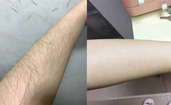 光子手臂脫毛是怎么做的？