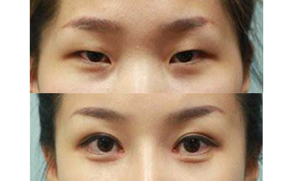 眼綜合手術多久能恢復自然？