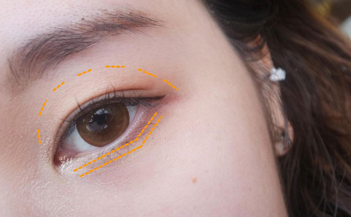 眼窩自體脂肪填充多少錢？自體脂肪豐眼窩成活率高嗎？