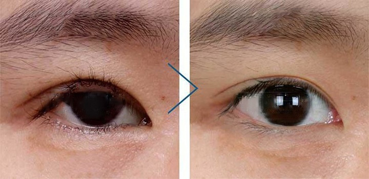 雙眼皮術后為什么出現(xiàn)眼瞼外翻?該怎么修復?