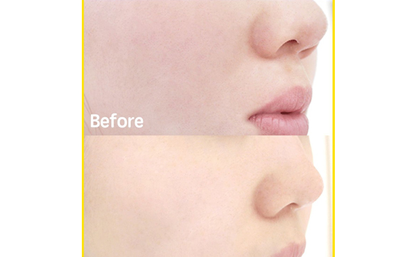 無針水光針有副作用嗎？