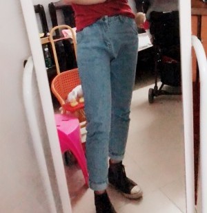 大腿吸脂后照片