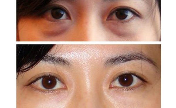 眼袋抽脂的手術(shù)過程是什么？