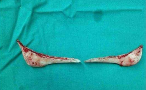 下頜角整形口內(nèi)切口和口外切口哪種方式更好？