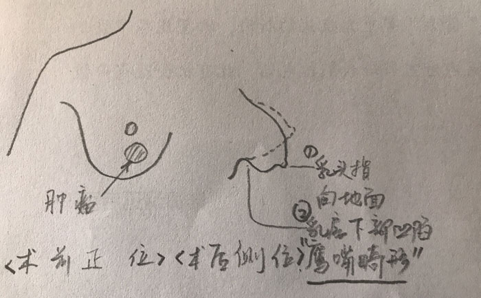 乳房畸形是什么原因造成的？乳房畸形矯正手術(shù)方法？