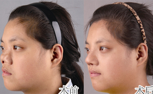 全鼻再造的方法有哪些?術(shù)后護(hù)理怎么做