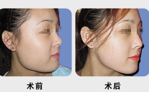 做下頜角整形手術(shù)前后要注意什么?