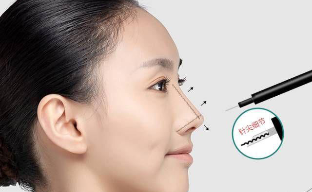 鼻部除皺的最好方法是什么？鼻部除皺多少錢？