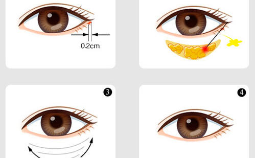 內(nèi)切眼袋怎么做？