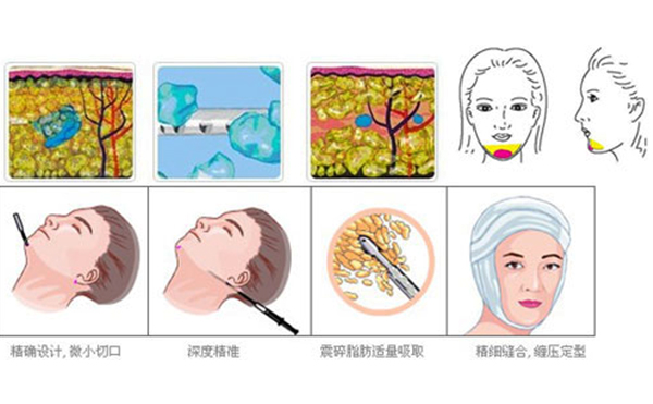 下巴整形吸脂術(shù)要多少錢？
